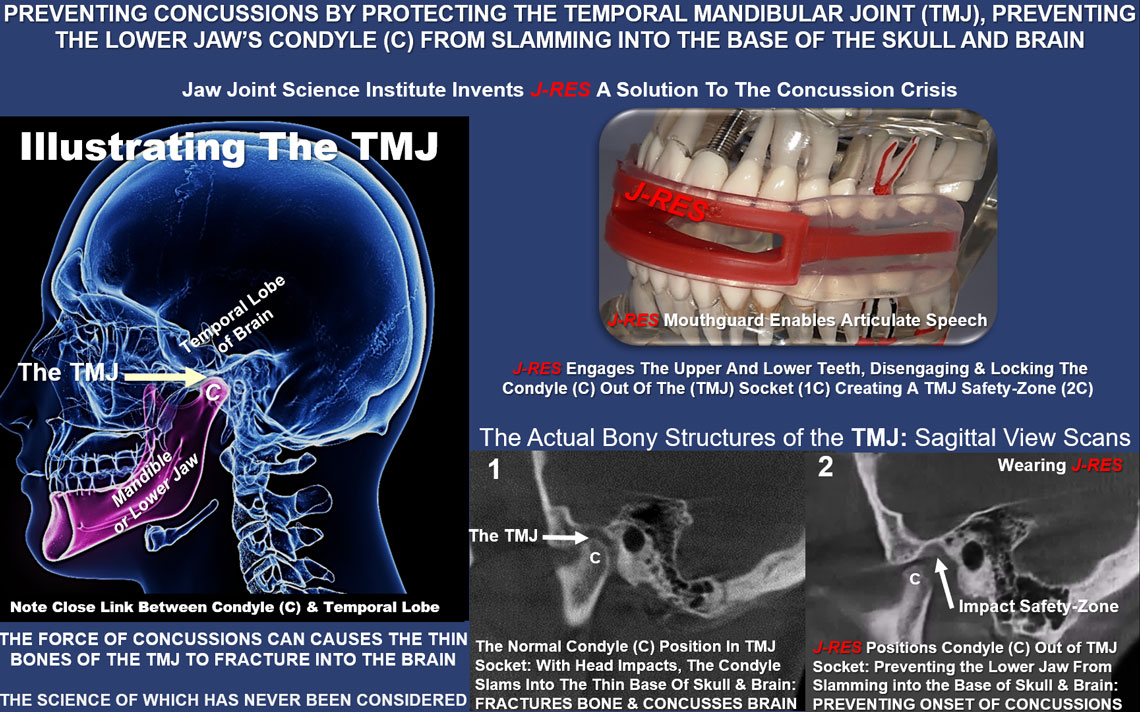 Preventing Concussions by Safeguarding the TMJ